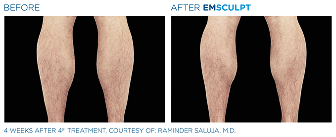 Emsculpt (calf)