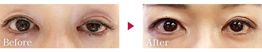 Eyelid droop surgery (incision)