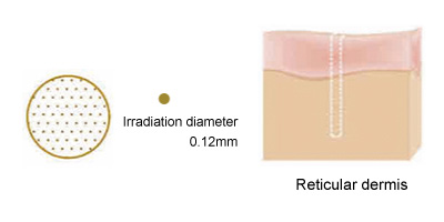 Irradiation diameter
 0.12mm　Reticular dermis