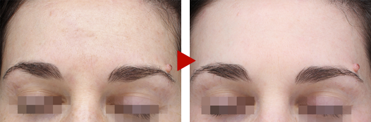 衣理式皮秒SkinRejuvenation